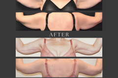 10_brachioplasty