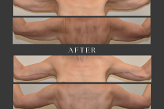 12_brachioplasty