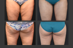 23_inner thigh lift