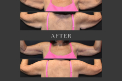 26_brachioplasty
