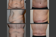 2_body lift