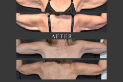 38_brachioplasty