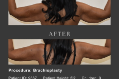 3_brachioplasty