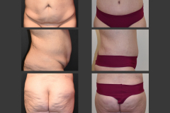 7_body lift