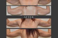 7_brachioplasty