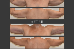 8_brachioplasty