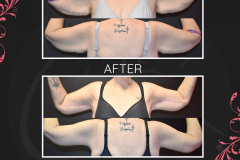 MAZ_BeforeAfter_Brachioplasty-1_7545