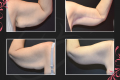 MAZ_BeforeAfter_Brachioplasty-2_7545