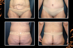bodylifts-0616