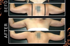 bodylifts-1339