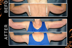 bodylifts-1506