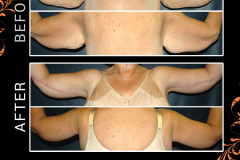 bodylifts-2167