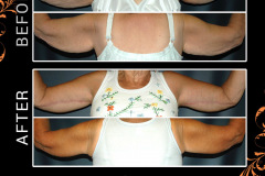 bodylifts-2231