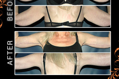bodylifts-2389