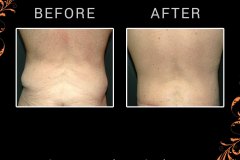 bodylifts-3409