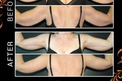 bodylifts-4948
