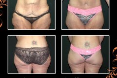 bodylifts-5522