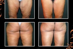 bodylifts-6286