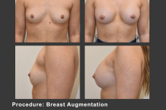10_breast aug
