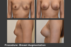 13_breast aug