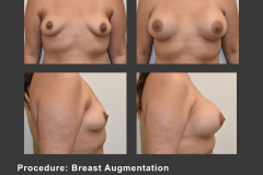 14_breast aug