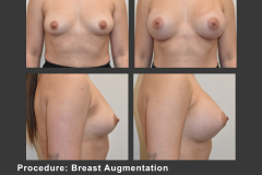 16_breast aug