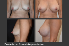 17_breast aug
