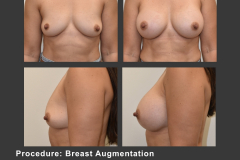 18_breast aug