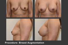 19_breast aug