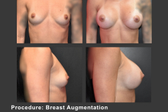 10_breast aug