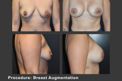 13_breast aug