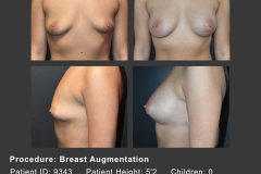 14_breast aug