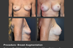 20_breast aug