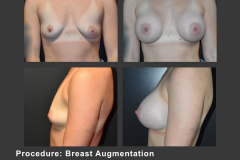 6_breast aug