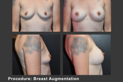 1_breast aug
