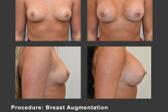 20_breast aug