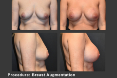 29_breast aug