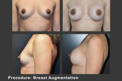 35_breast aug