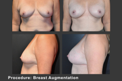 36_breast aug