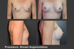 45_breast aug