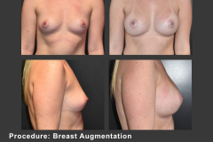 46_breast aug