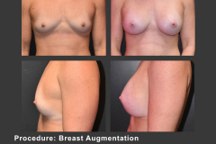 47_breast aug
