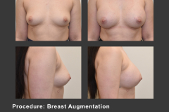 4_breast aug