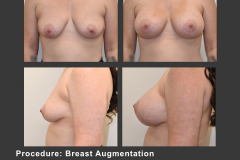 5_breast aug