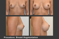 6_breast aug