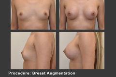 8_breast aug