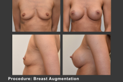 9_breast aug