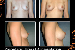 BreastAug-0315