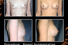 BreastAug-0581