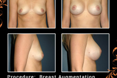 BreastAug-0708